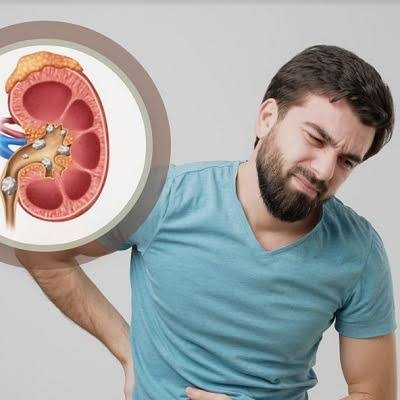 حصوات الكلى والحالب: الأعراض وطرق العلاج
